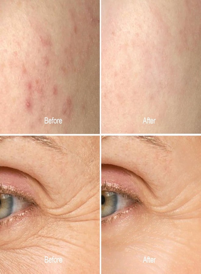 Aphrona LED skin light therapy Face mini patch| LED skin care Red and Blue Light therapy Patch| Led Skin Care Hydrocolloid Patch| Rechargeable eye patch led mini face patch - Image 4